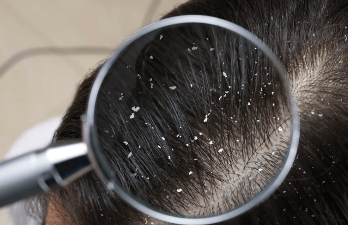 How do I fix my dry scalp fast?