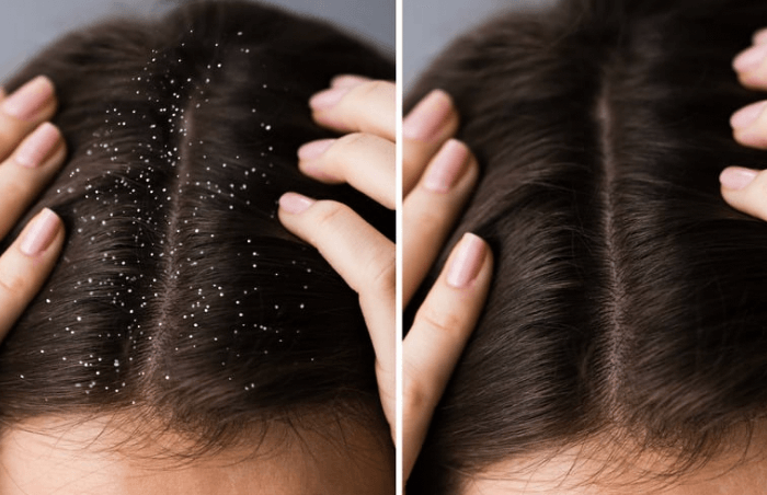 How do I fix my dry scalp fast?