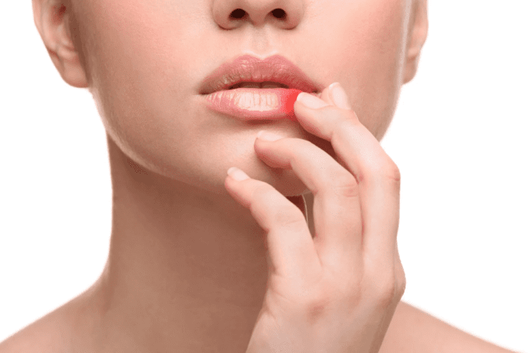 How to Heal That Annoying Sore in the Corner of Your Mouth: Remedies for Angular Cheilitis