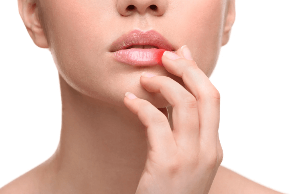 How to Heal That Annoying Sore in the Corner of Your Mouth: Remedies for Angular Cheilitis